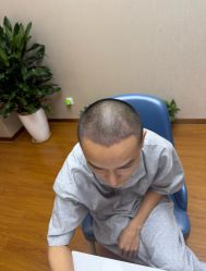 -大麦微针植发全国连锁