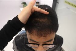 -大麦微针植发丨全国连锁