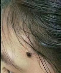 -北京美痣堂古方祛痣斑疣瘊
