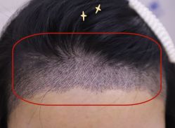 -大麦微针植发全国连锁