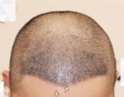 -大麦微针植发全国连锁