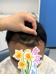 -大麦微针植发全国连锁