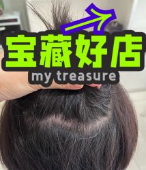 体验后-大麦微针植发丨全国连锁