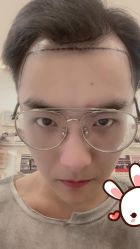 -大麦微针植发丨全国连锁