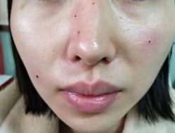 -北京美痣堂古方祛痣斑疣瘊