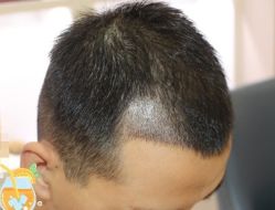 -大麦微针植发丨全国连锁