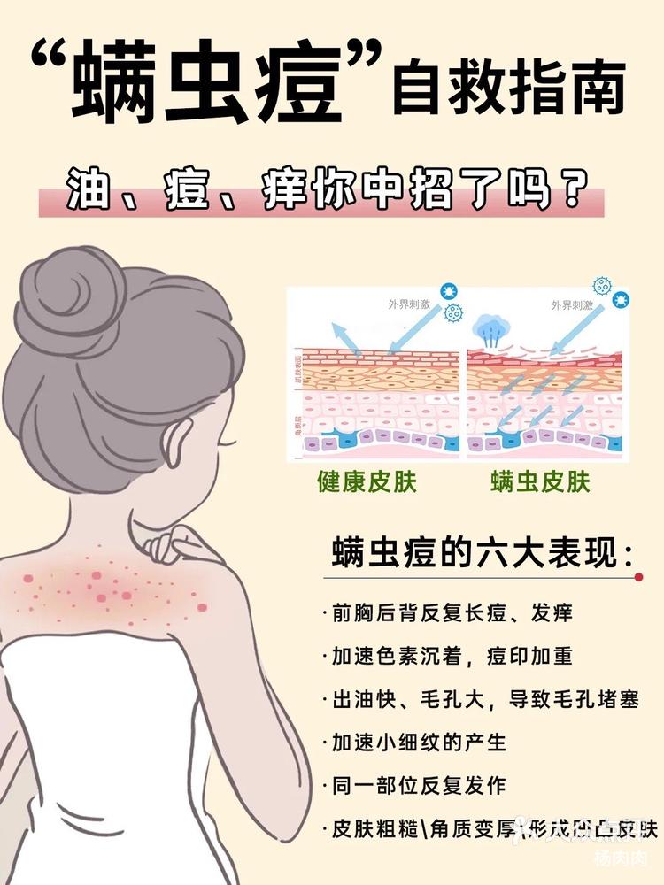 前胸后背皮肤发痒反复长痘居然是螨虫