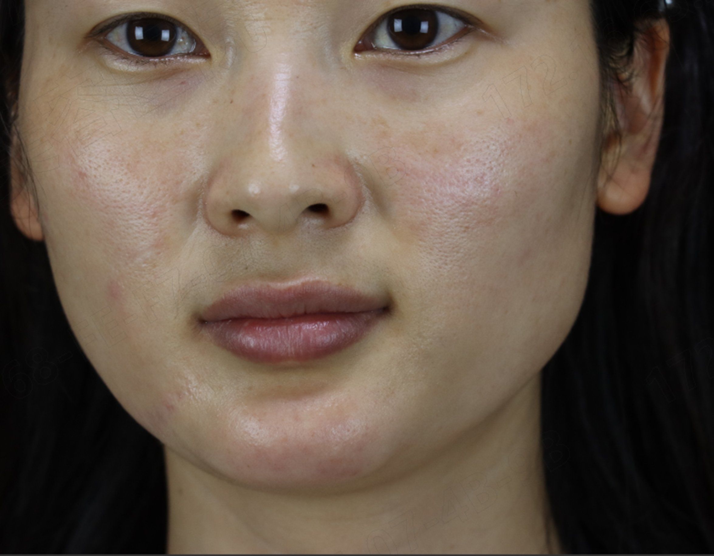 【激光淡疤】激光淡疤5个月效果分享