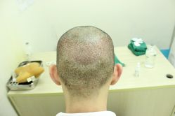 点击看大图 -大麦微针植发丨全国连锁