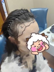 -大麦微针植发全国连锁