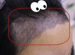 -大麦微针植发全国连锁