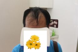 -大麦微针植发丨全国连锁