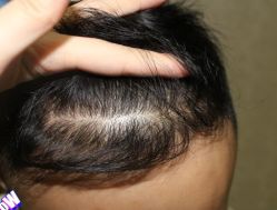 -大麦微针植发丨全国连锁