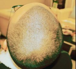 -大麦微针植发丨全国连锁