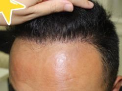 -大麦微针植发丨全国连锁