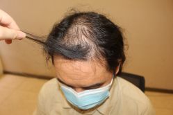 -大麦微针植发丨全国连锁