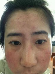 -美丽人生祛斑扁平疣汗管瘤中心