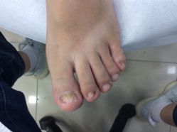 点击看大图 -德哥灰指甲脚气甲沟炎跖疣护理