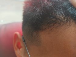 -碧莲盛·不剃发植发