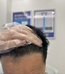 -大麦微针植发全国连锁