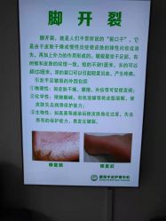点击看大图 -德哥灰指甲脚气甲沟炎跖疣护理