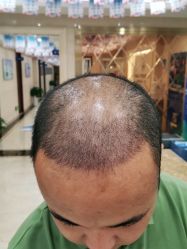 -碧莲盛·不剃发植发