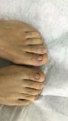 点击看大图 -德哥灰指甲脚气甲沟炎跖疣护理