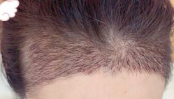 -大麦微针植发丨全国连锁