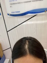 点击看大图 -碧莲盛·不剃发植发