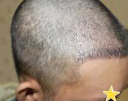 -大麦微针植发丨全国连锁