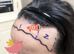 -大麦微针植发全国连锁