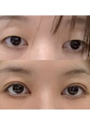 体验前-苏州维多利亚美容医院