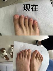 -德哥灰指甲脚气甲沟炎跖疣护理
