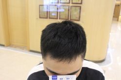 -大麦微针植发丨全国连锁