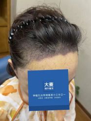 -大麦微针植发全国连锁