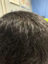 点击看大图 -碧莲盛·不剃发植发