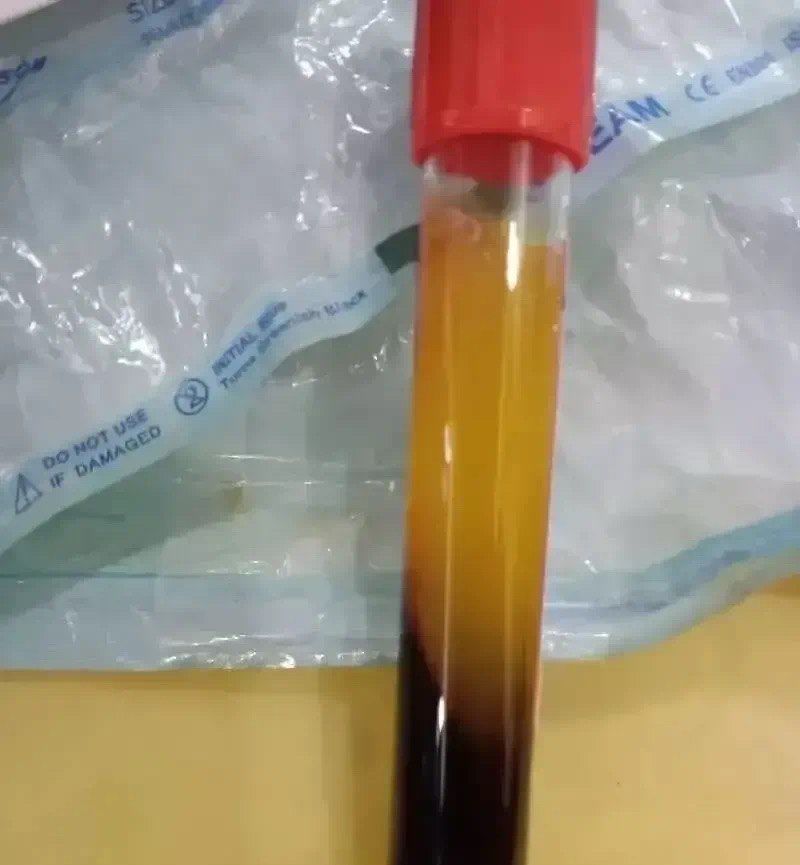 口腔治疗新选择!cgf浓缩生长因子:加速愈合