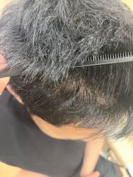 -大麦微针植发全国连锁