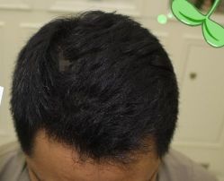 -大麦微针植发丨全国连锁