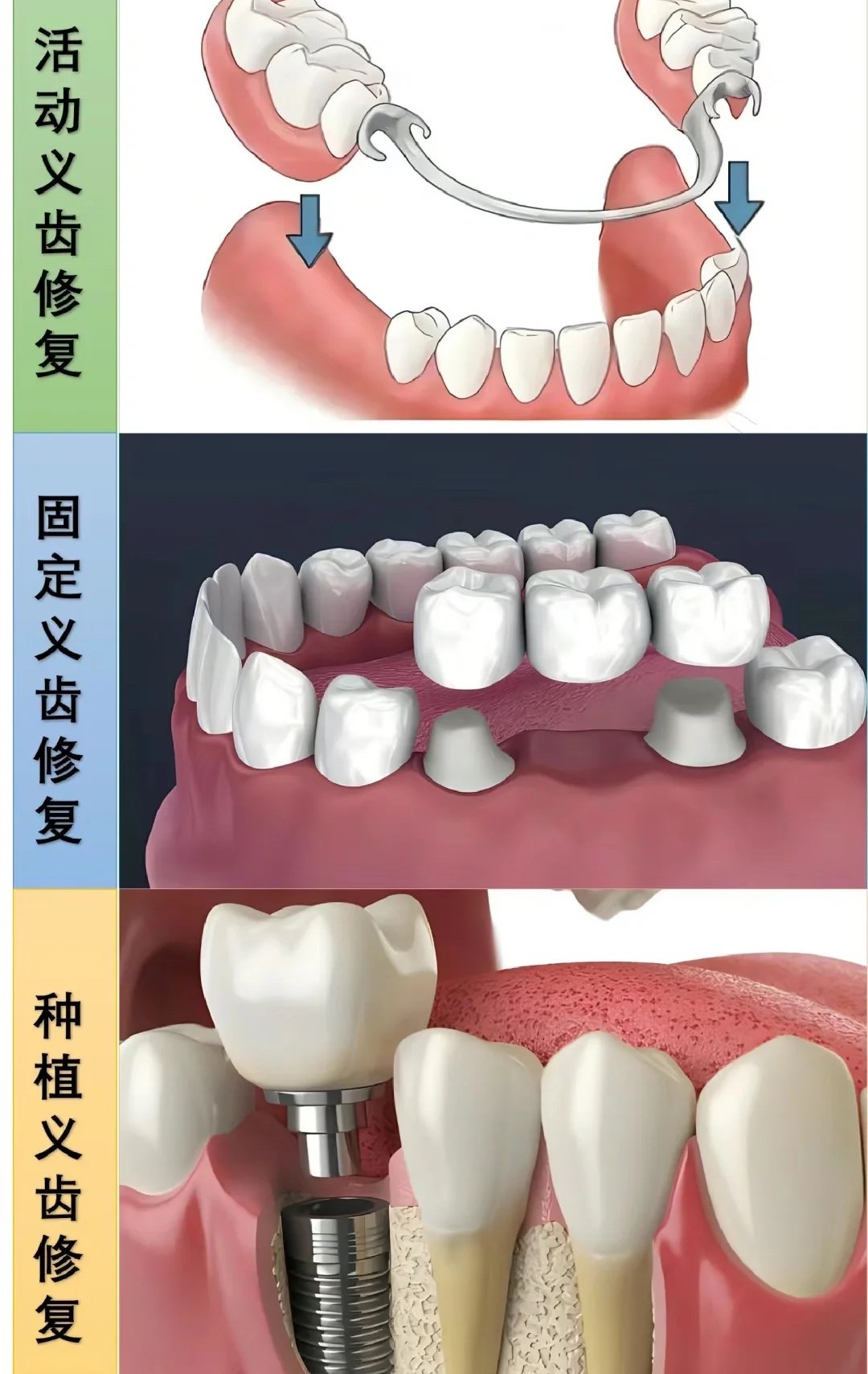 瓜子牙修补图解图片