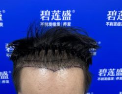 -碧莲盛·不剃发植发