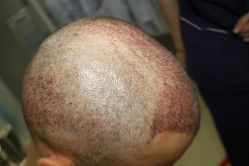 -大麦微针植发丨全国连锁