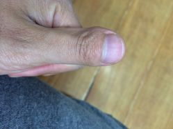 铭甲科技灰指甲-EPAI·灰指甲·甲沟炎·嵌甲护理
