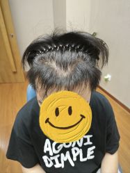 -大麦微针植发全国连锁