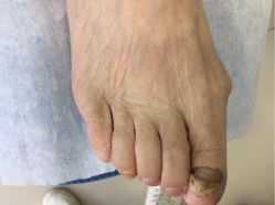 -德哥灰指甲脚气甲沟炎跖疣护理