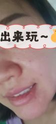 体验前-北京丽星翼美医疗美容