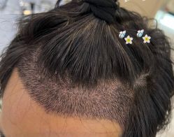 -大麦微针植发全国连锁