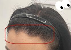 -大麦微针植发全国连锁