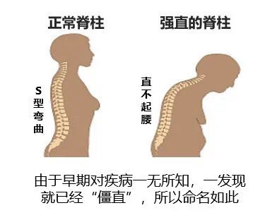 强直晚期图片