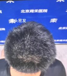 -北京雍禾植发医院